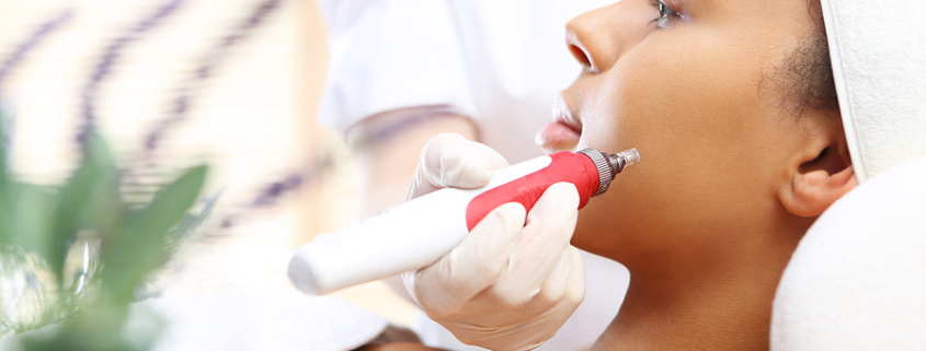 microneedling treatment
